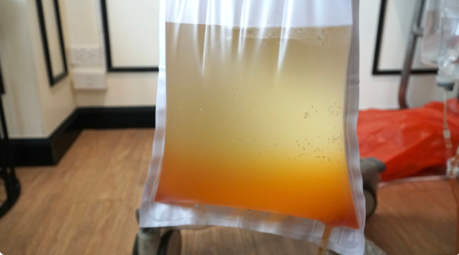 Bag of filtered plasma collected during a DFPP session at LINNA Clinic Bangkok