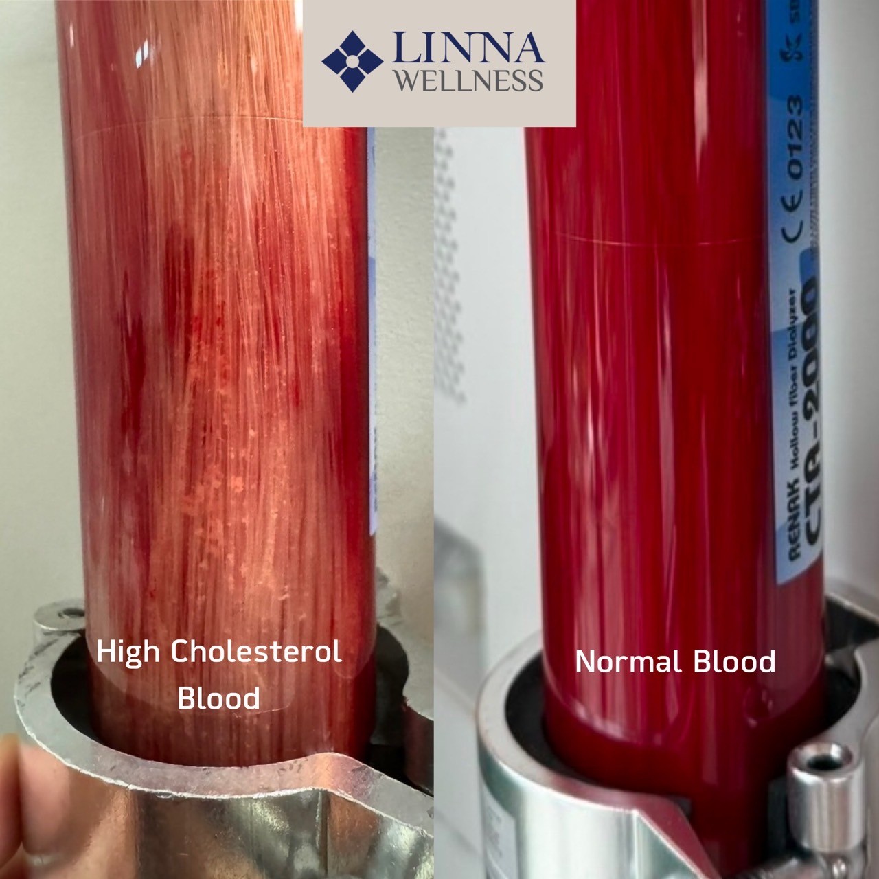 EBOO blood filter comparison documented at LINNA Clinic Bangkok