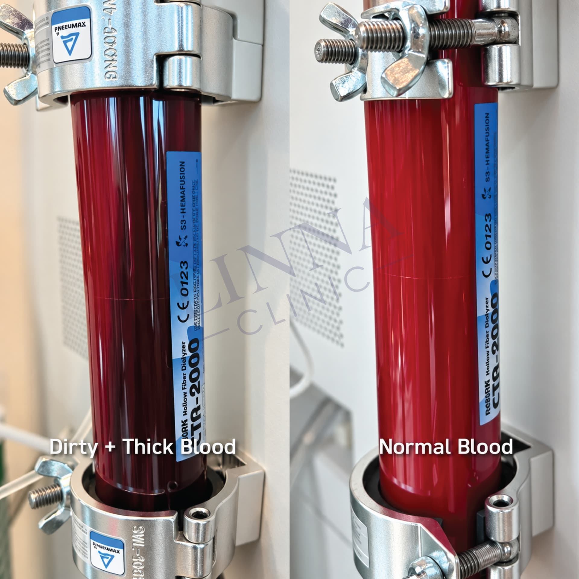 EBOO filter comparison documented at LINNA Clinic Bangkok
